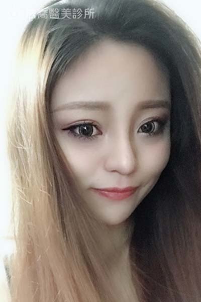 法喬醫美診所自體肋骨隆鼻術後1個月