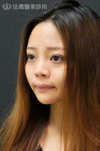 法喬醫美診所自體肋骨隆鼻術前