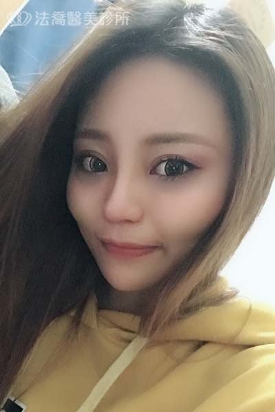 法喬醫美診所自體肋骨隆鼻術後1個月