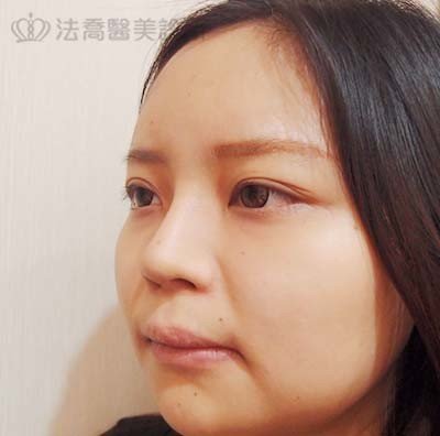 法喬醫美診所自體肋骨隆鼻術後6個月
