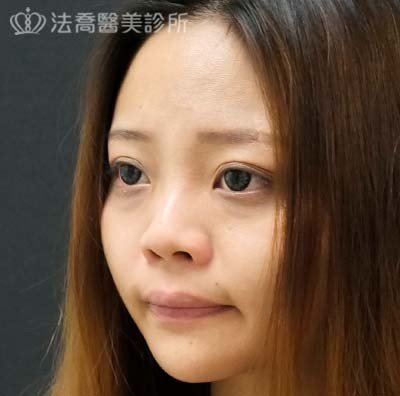 法喬醫美診所自體肋骨隆鼻術前