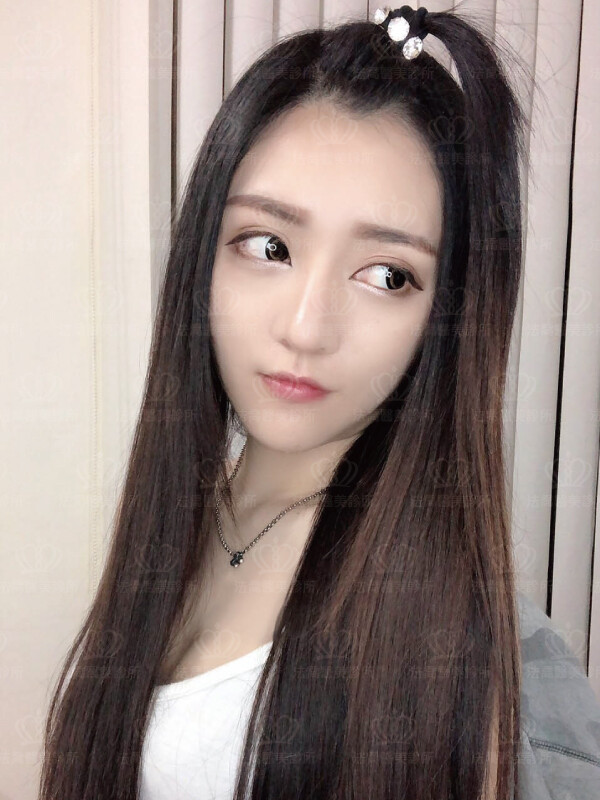 法喬醫美診所術後3個月案例