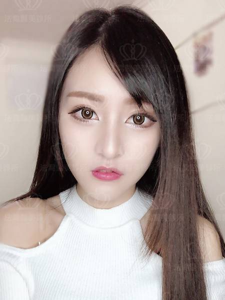 法喬醫美邱浚彥隆鼻案例