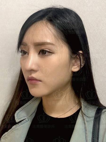 法喬醫美診所術後案例