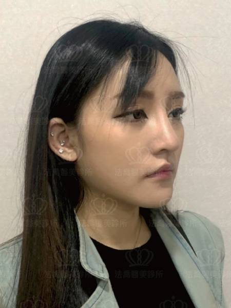 自體肋骨權威邱浚彥術後案例