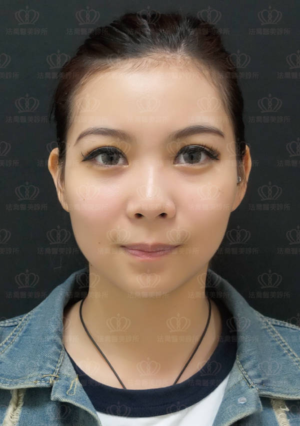 自體肋骨隆鼻