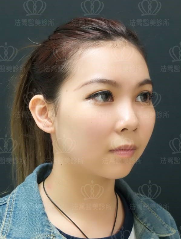 自體肋骨隆鼻
