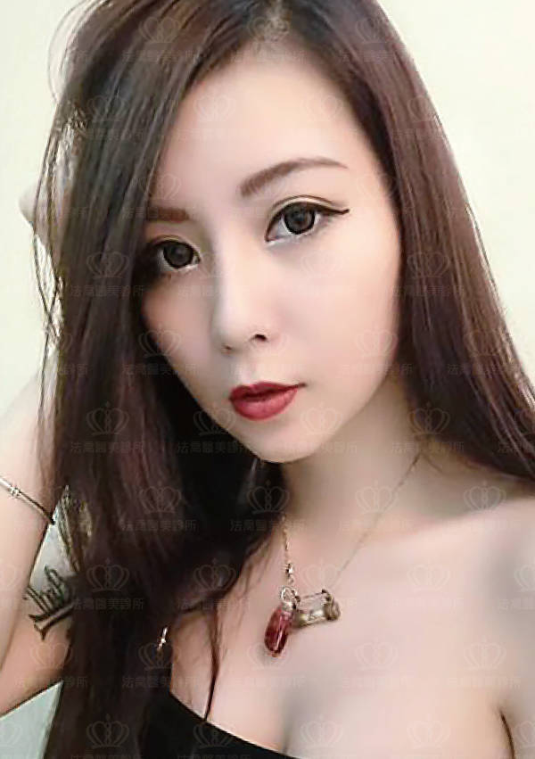 自體肋骨隆鼻