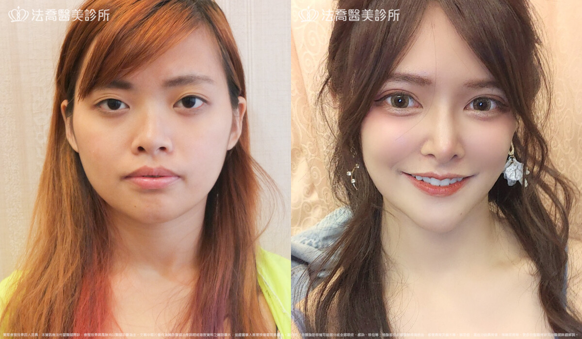 法喬醫美診所,邱浚彥,自體肋骨隆鼻