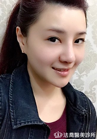 自體肋骨隆鼻