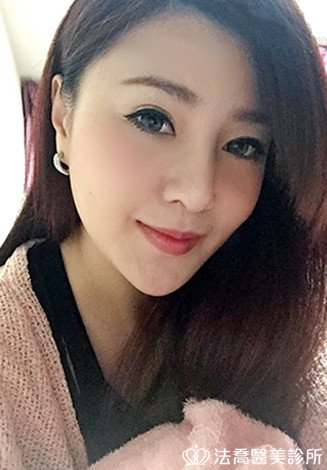 自體肋骨隆鼻