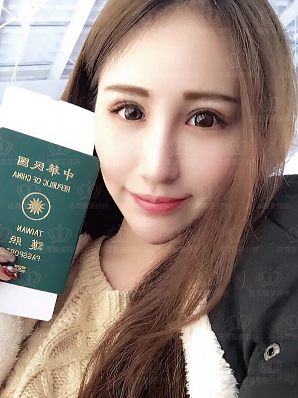 法喬醫美診所自體肋骨隆鼻術後一個月BA圖