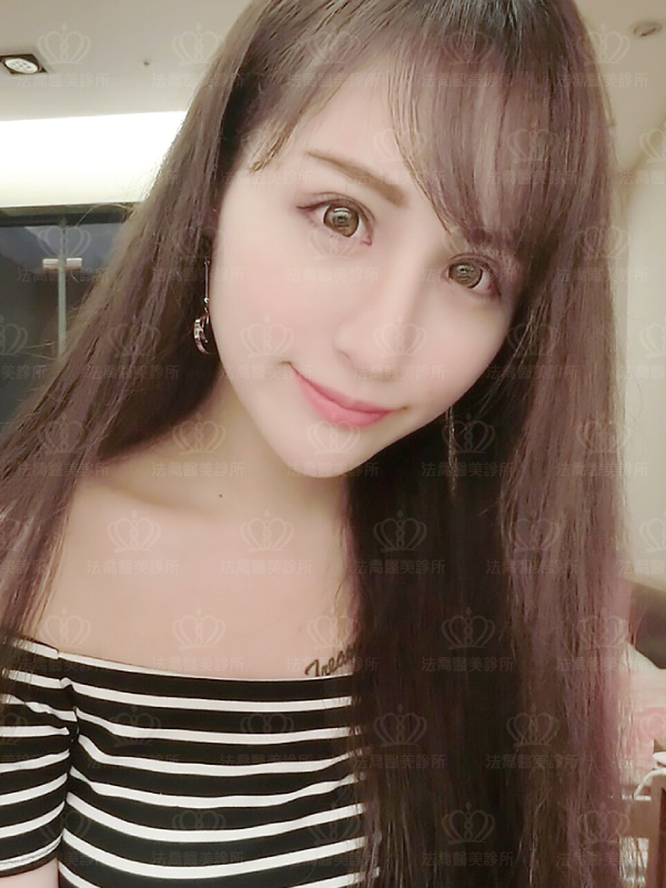 法喬醫美診所自體肋骨隆鼻術後一個月BA圖