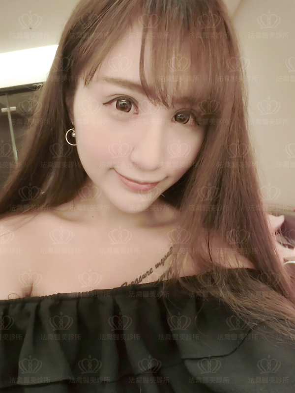 法喬醫美診所自體肋骨隆鼻術後一個月BA圖