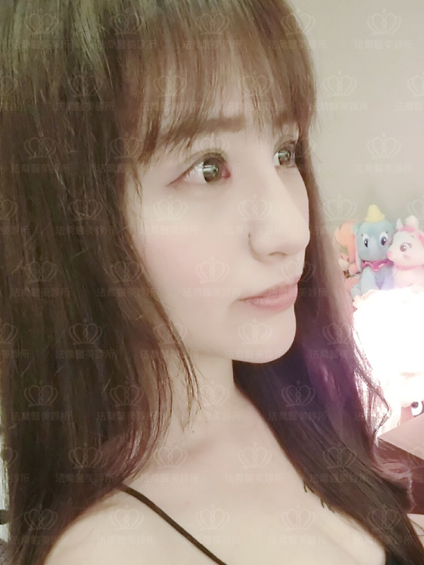 法喬醫美診所自體肋骨隆鼻術後15天BA圖