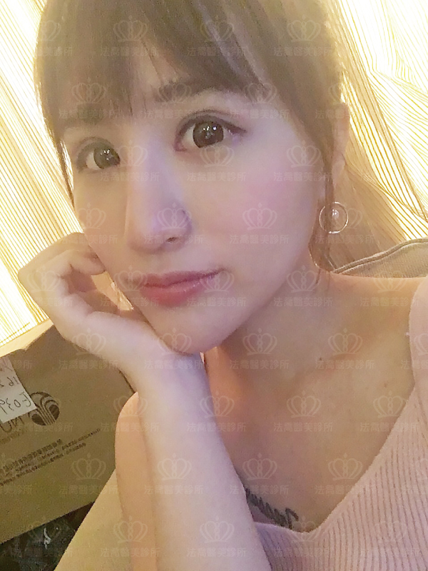 法喬醫美診所自體肋骨隆鼻術後15天BA圖