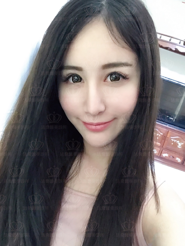 法喬醫美診所自體肋骨隆鼻術後三個月BA圖