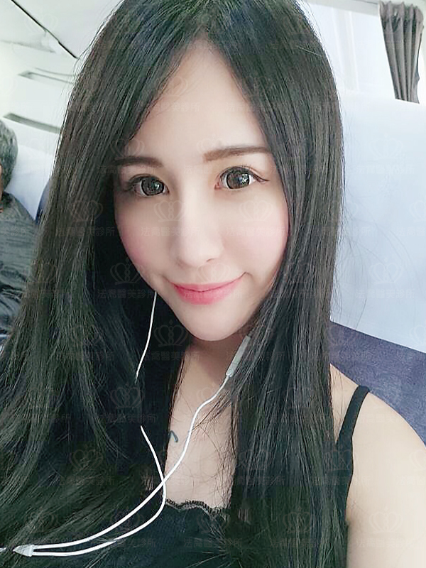 法喬醫美診所自體肋骨隆鼻術後六個月BA圖