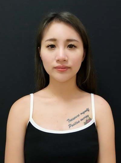 法喬醫美診所自體肋骨隆鼻術後一個月BA圖