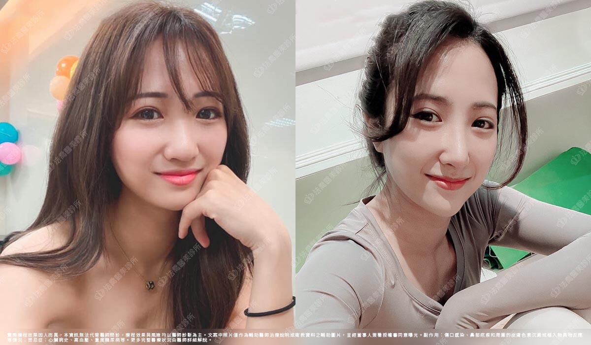 自體肋骨隆鼻,法喬醫美診所,邱浚彥
