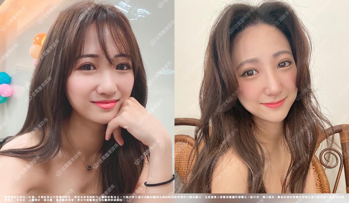 法喬醫美診所,邱浚彥,自體肋骨隆鼻,隆鼻推薦