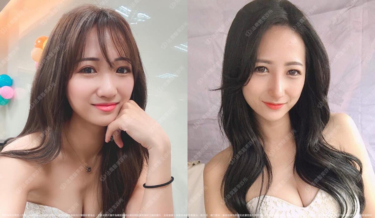 自體肋骨隆鼻,法喬醫美診所,邱浚彥