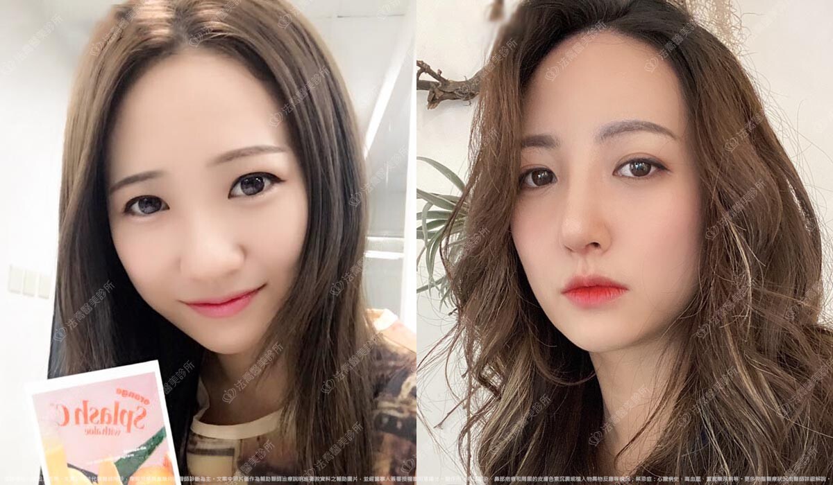 法喬醫美診所,邱浚彥,自體肋骨隆鼻,隆鼻推薦