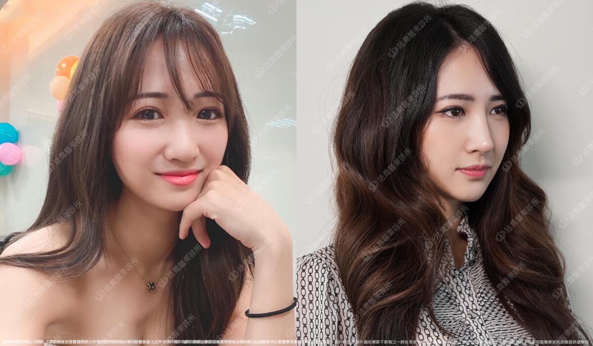 自體肋骨隆鼻,法喬醫美診所,邱浚彥