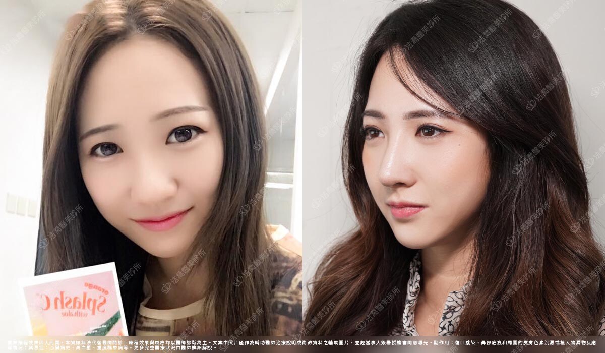 自體肋骨隆鼻,法喬醫美診所,邱浚彥