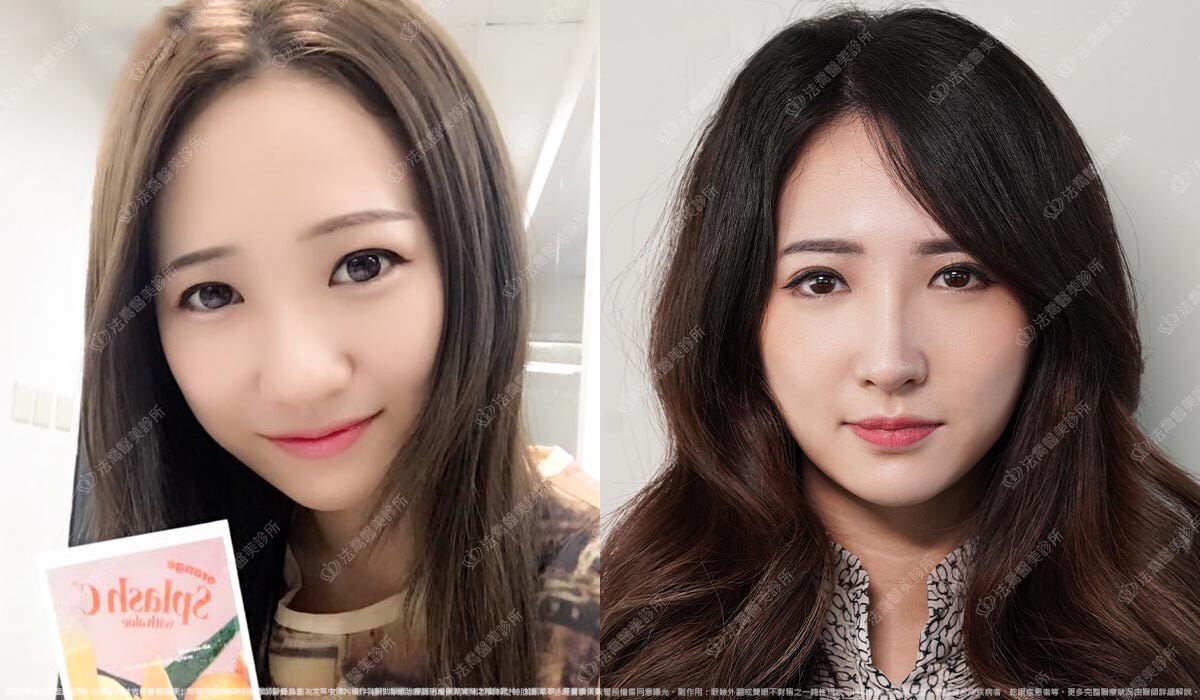 法喬醫美診所,邱浚彥,自體肋骨隆鼻,隆鼻推薦