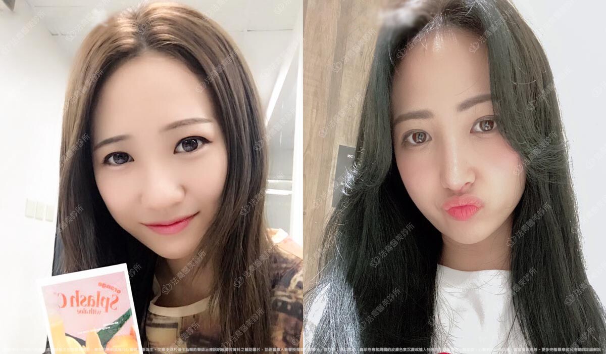 自體肋骨隆鼻,法喬醫美診所,邱浚彥