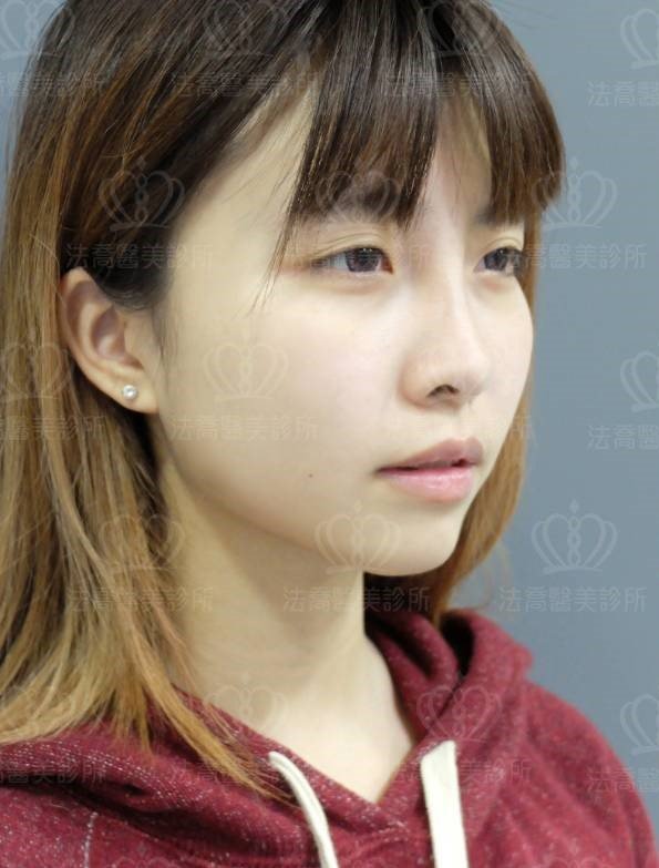 自體肋骨隆鼻