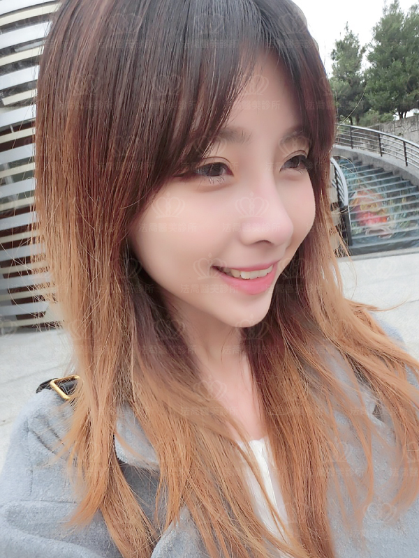 自體肋骨隆鼻