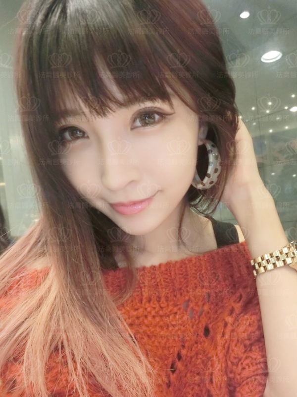 自體肋骨隆鼻