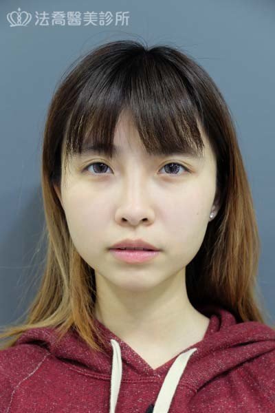 自體肋骨隆鼻