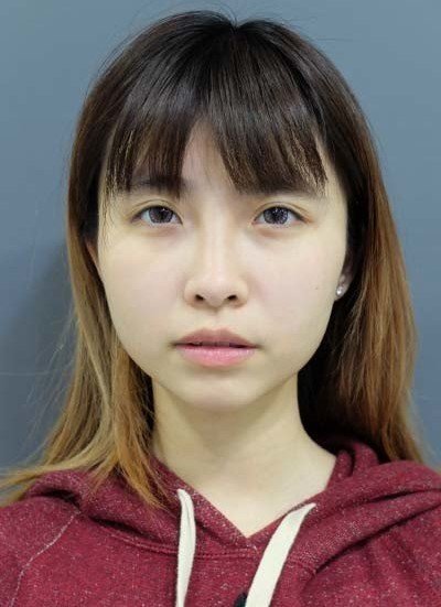 自體肋骨隆鼻
