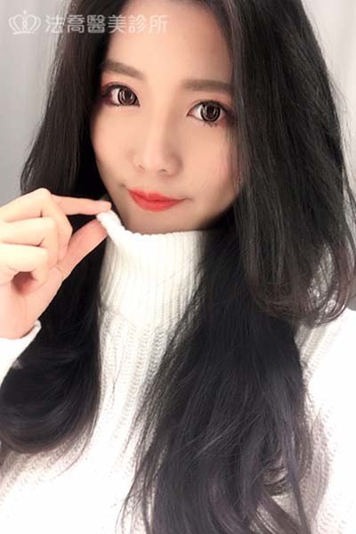 自體肋骨隆鼻