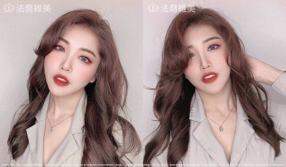 法喬醫美診所,邱浚彥,隆鼻,隆鼻重修