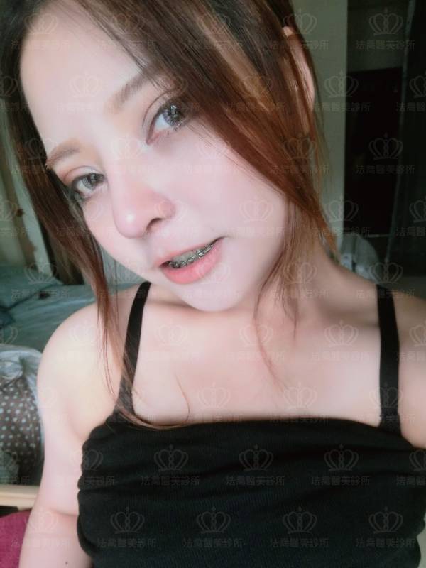 法喬醫美診所自體肋骨隆鼻術後