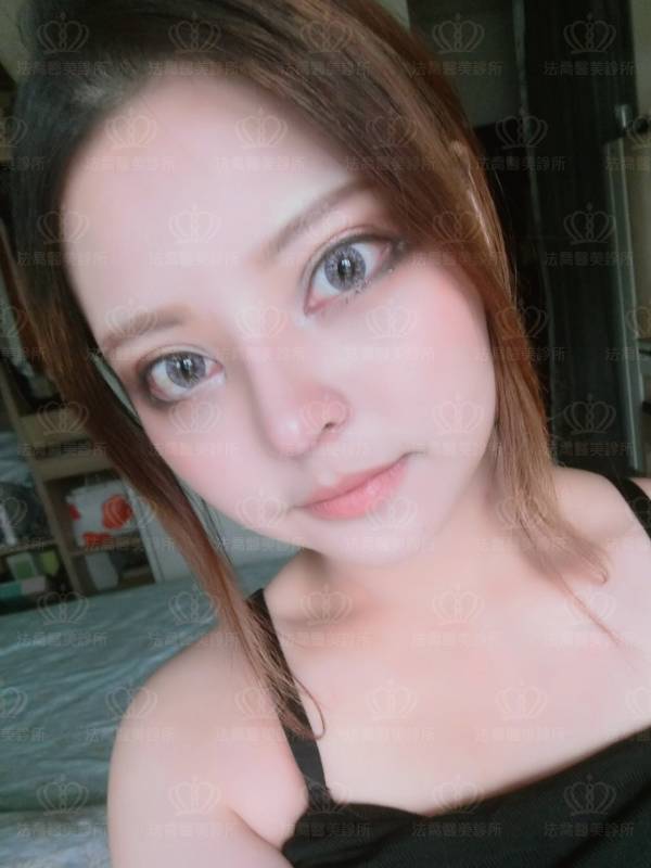 法喬醫美診所自體肋骨隆鼻術後