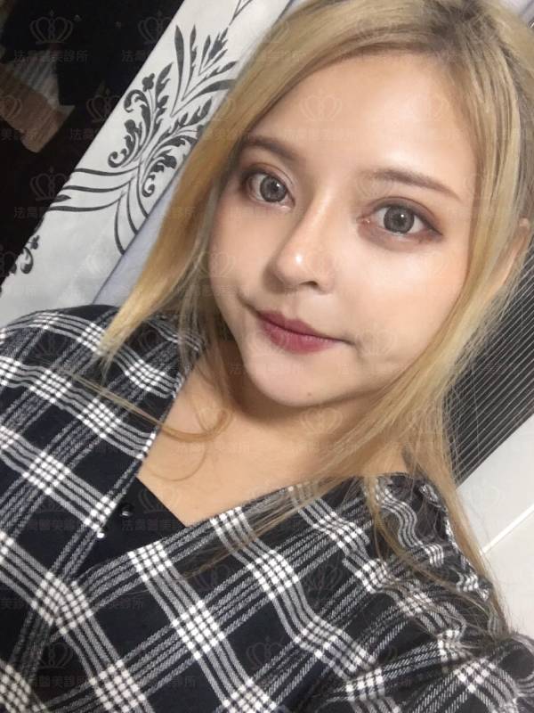 法喬醫美診所自體肋骨隆鼻術後