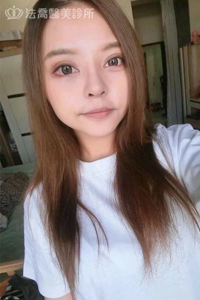 自體肋骨隆鼻