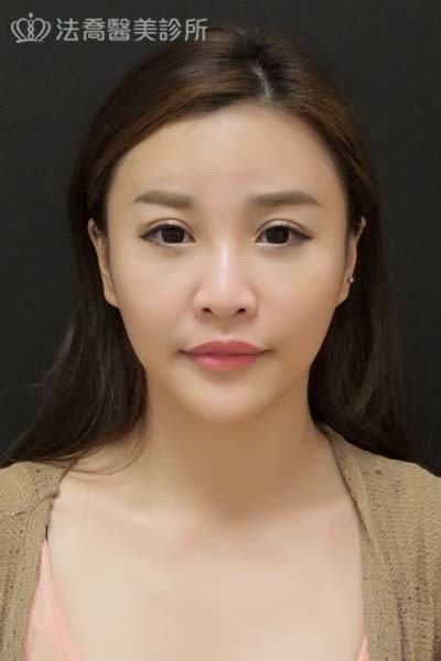 自體肋骨隆鼻
