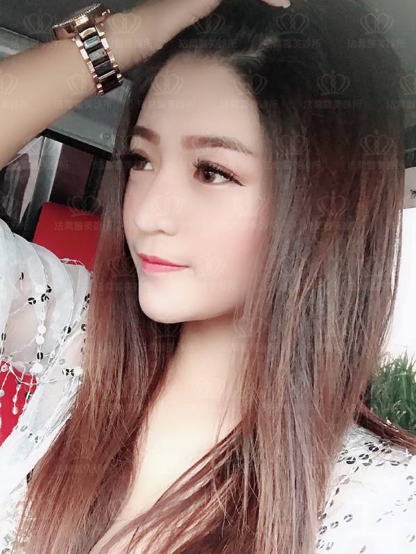自體肋骨隆鼻