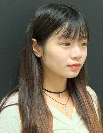 自體肋骨隆鼻