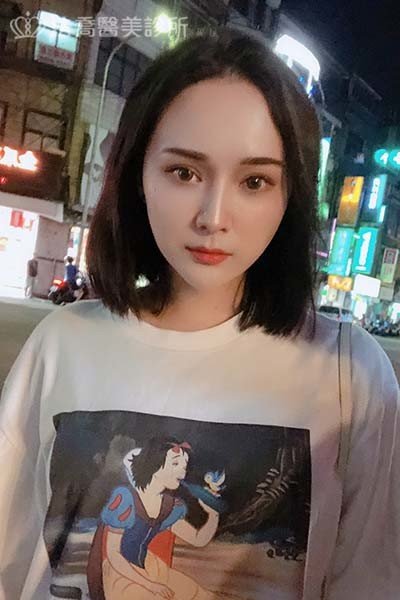 自體肋骨隆鼻