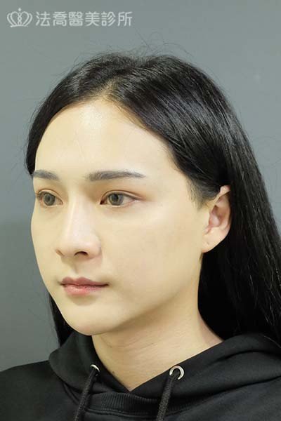 自體肋骨隆鼻