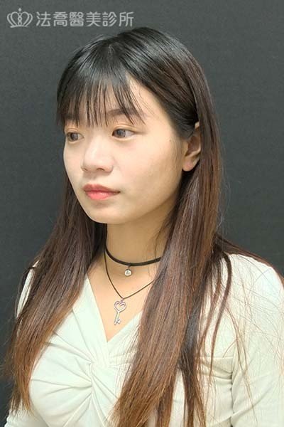 自體肋骨隆鼻