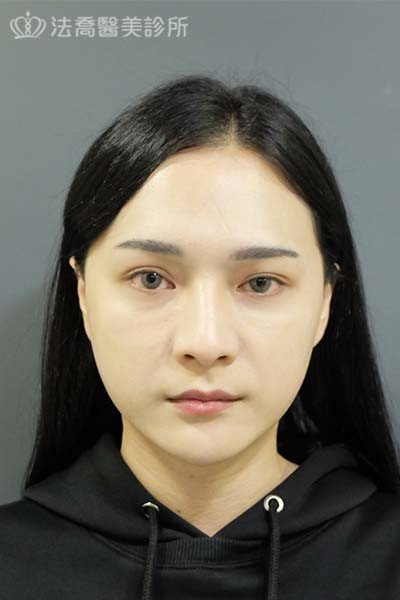 自體肋骨隆鼻