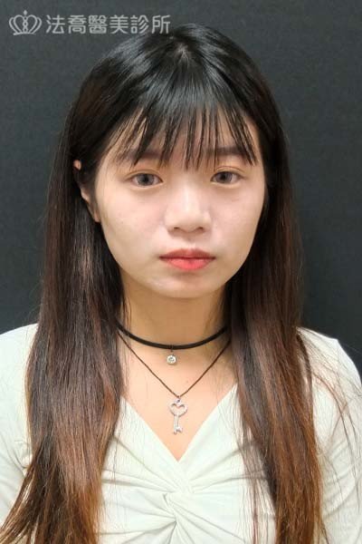 法喬醫美診所_自體肋骨隆鼻+縮鼻翼術後45天